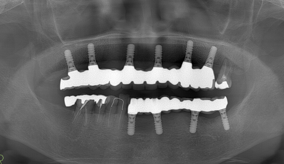 レントゲン写真