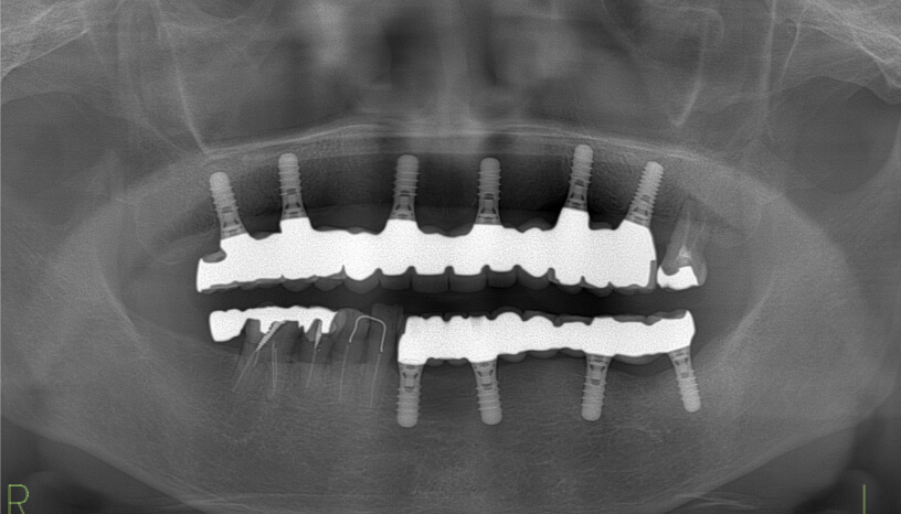 レントゲン写真