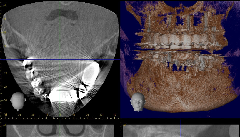 レントゲン写真