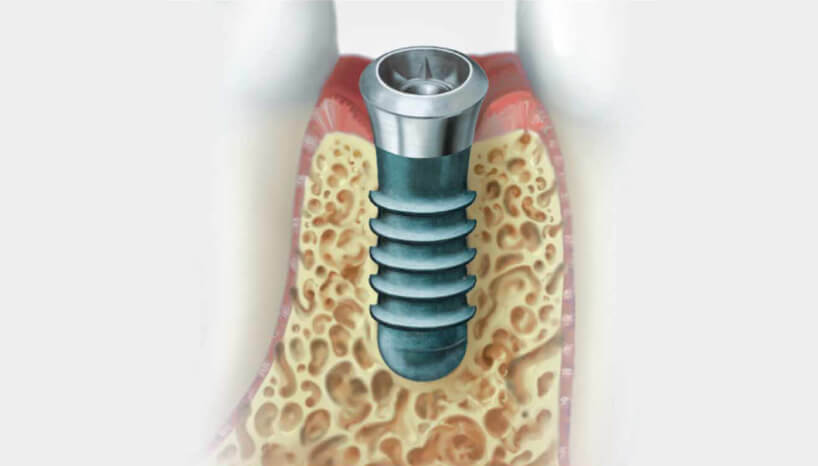 インプラント埋入の図