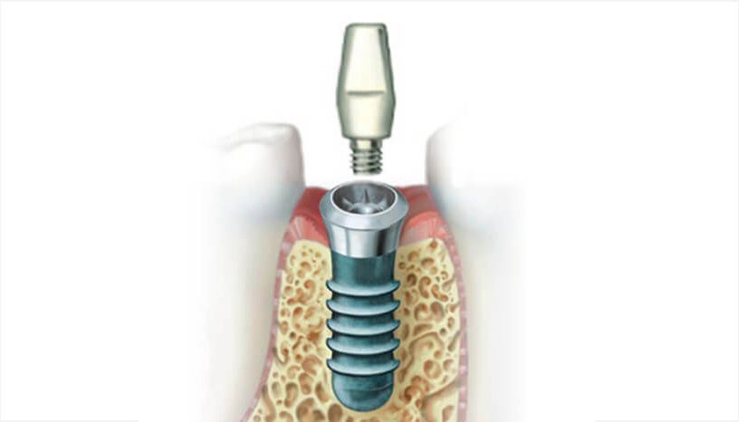 二次処置アバットメント取付の図