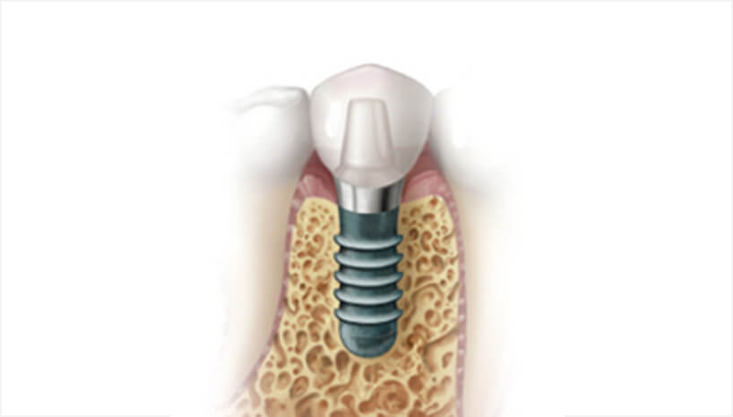 完成したインプラントの図