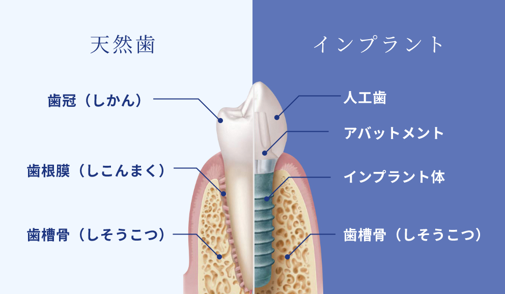 天然歯とインプラントの違い