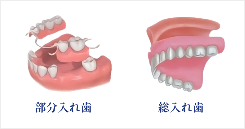 義歯（入れ歯）
