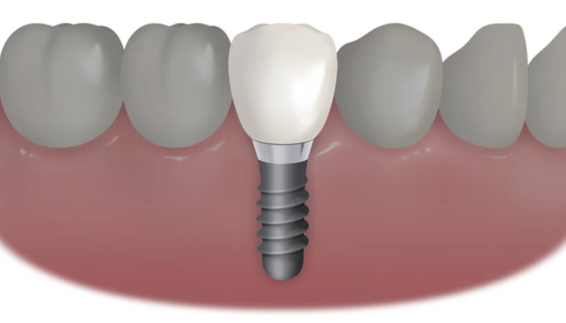 歯を1本失った 場合の治療例