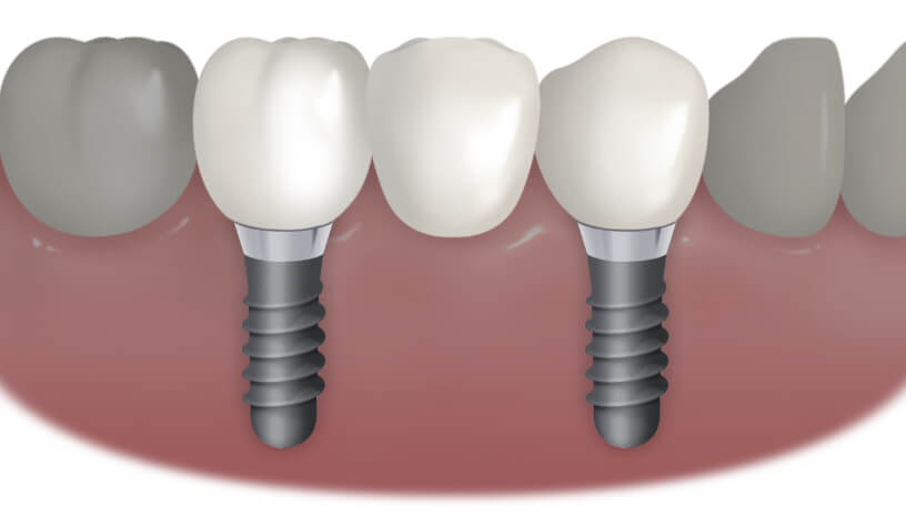歯を3本失った方の場合