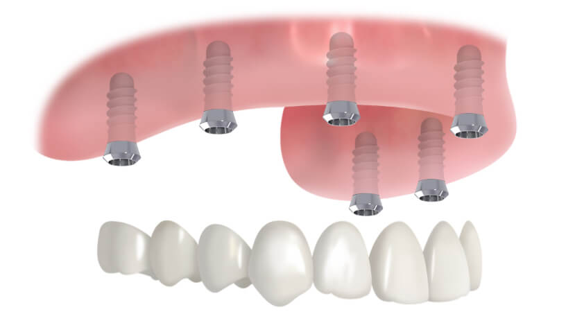 歯を12本失った場合の治療例