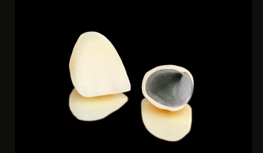 プラスチック・銀歯