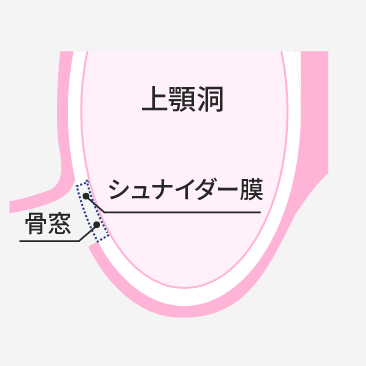 サイナスリフト法 STEP1