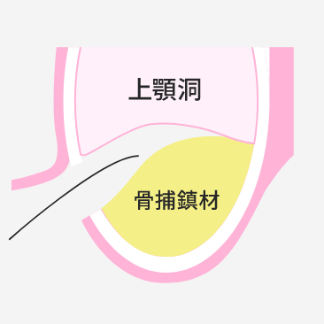 インプラント治療の技術と実績｜名古屋歯科