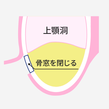 サイナスリフト法 STEP3