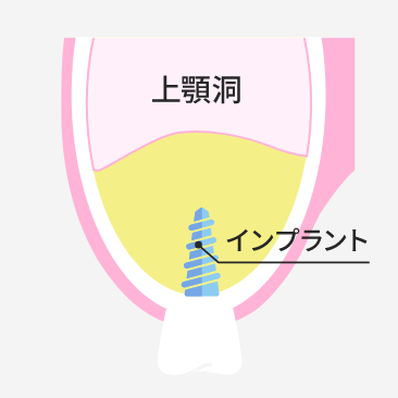 サイナスリフト法 STEP4