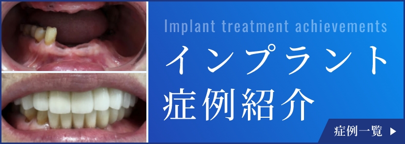 インプラント治療なら名古屋の名古屋歯科|多数の実績で評判の歯医者 インプラント治療なら名古屋の名古屋歯科|多数の実績で評判の歯医者