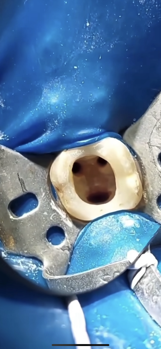 ポイントは細菌の除去率