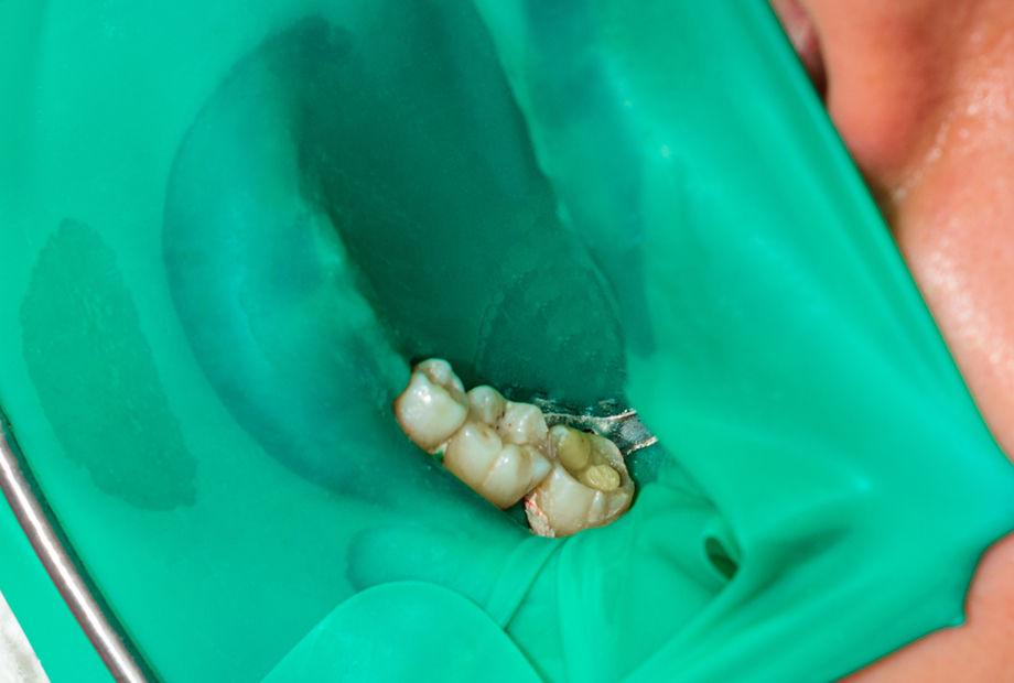 無菌環境での治療のために重要なラバーダム