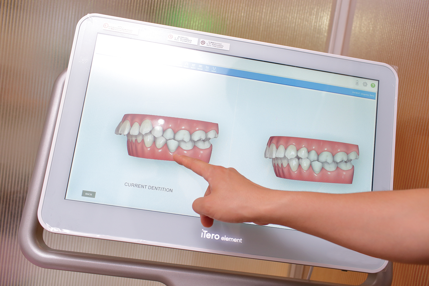 優れた予測実現性。無料で歯のシミュレーションができる