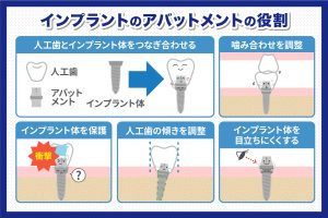 インプラントのアバットメントとは？