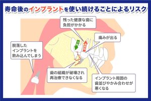 寿命後のインプラントを使い続けるリスク