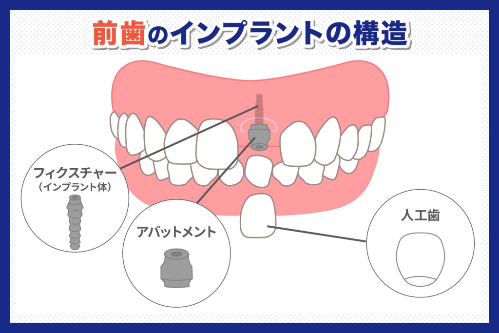 前歯のインプラントとは