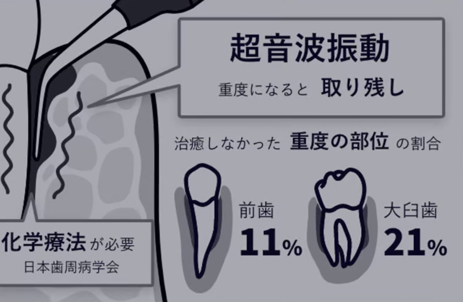 従来の治療法|超音波振動のみ