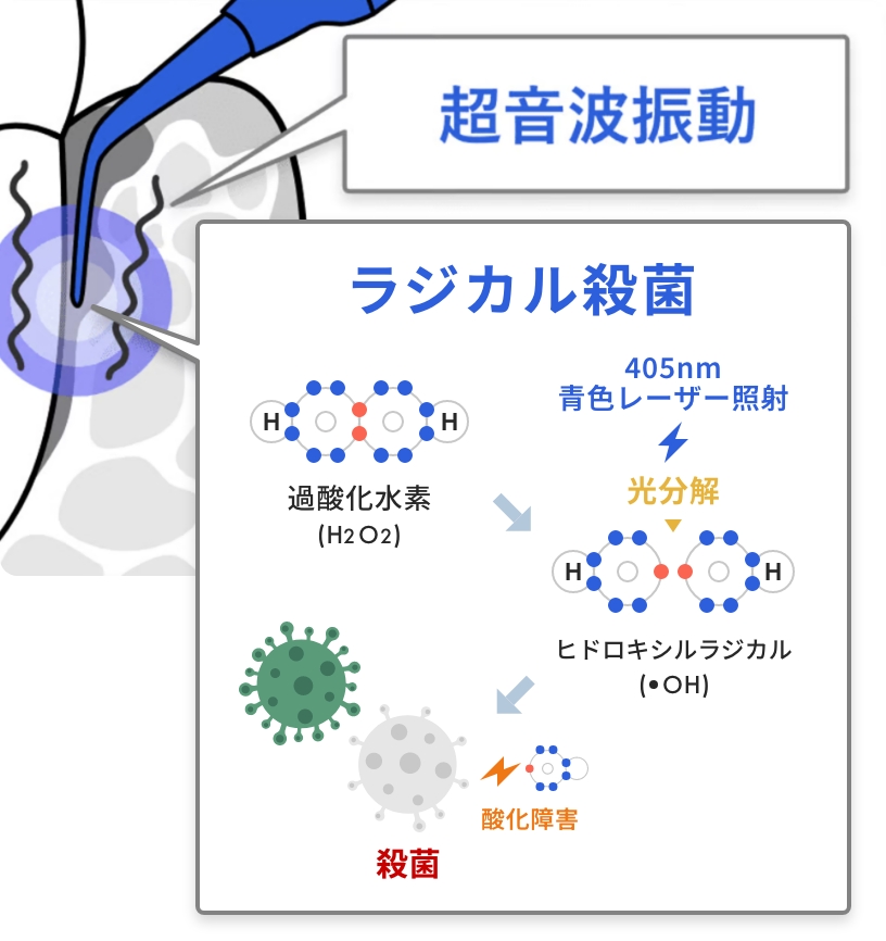 ブルーラジカル治療|超音波振動 + ラジカル殺菌(過酸化水素分解殺菌技術)